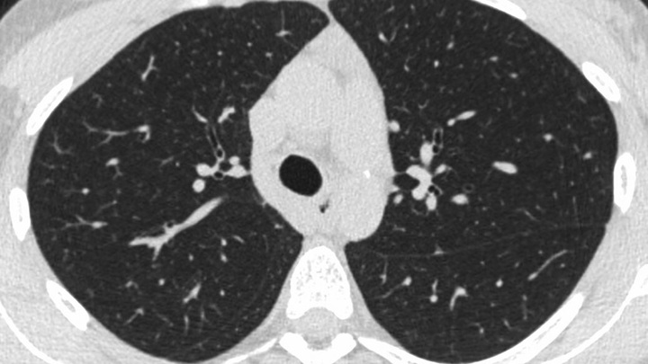 Вейп вызывает попкорновую болезнь легких: что такое EVALI и какие симптомы