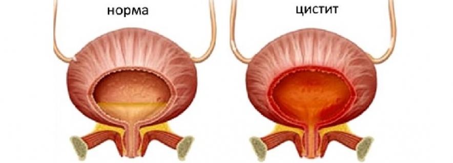 Можно ли вылечить хронический цистит навсегда: советы комплексного специалиста