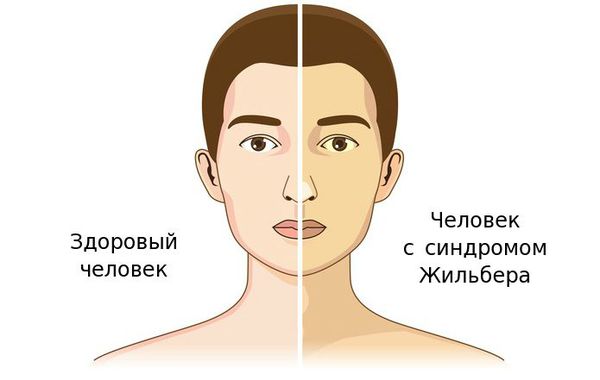 Синдром Жильбера у женщин, влияние на гормональный фон