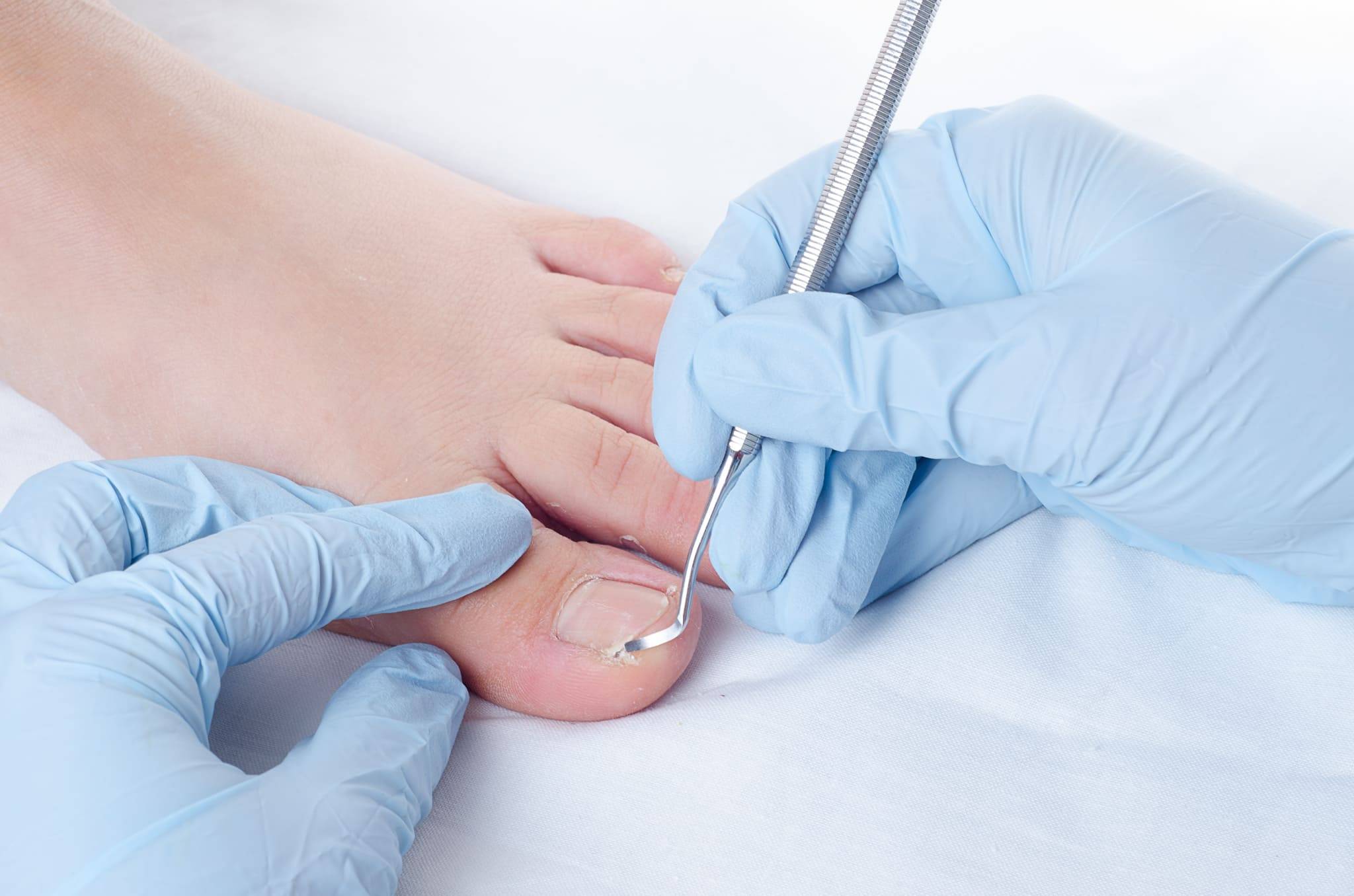 Хирургическое удаление вросшего ногтя – лечение сложных случаев